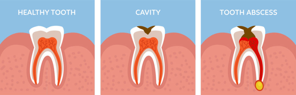 What Are The Most Common Causes Of Toothaches