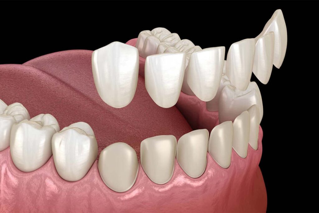 What to Expect During Veneer Treatment