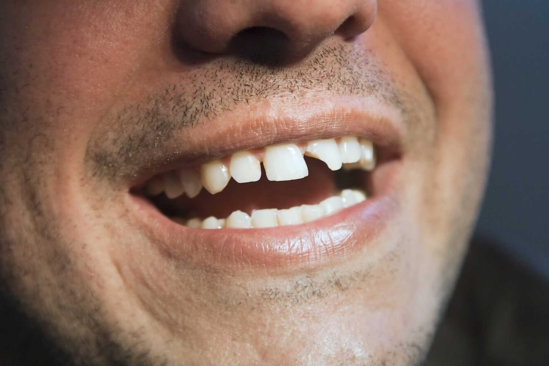 Cracked or Broken Tooth