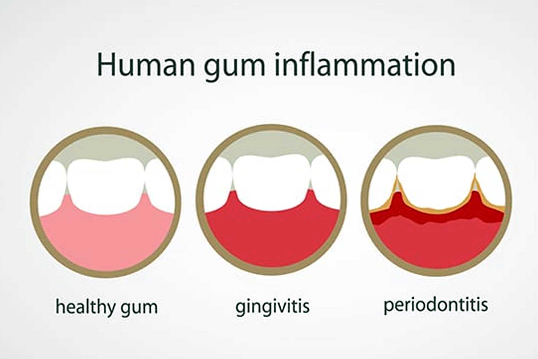 Swollen or Painful Gums