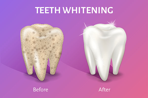 What Do Dentists Say About Teeth Whitening?