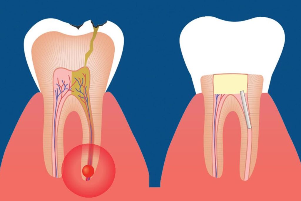 What to Expect During Your Root Canal Treatment